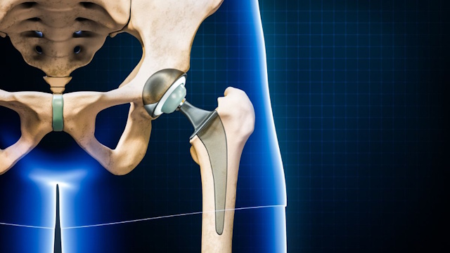 chirurgia di revisione
